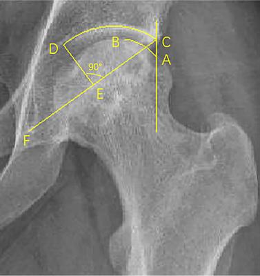 Evaluation of the predictive values of collapse and necrotic lesion boundary for osteonecrosis of the femoral head prognosis